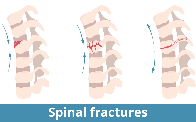 DR JONATHAN SURIEL Trauma vertebro-Medular